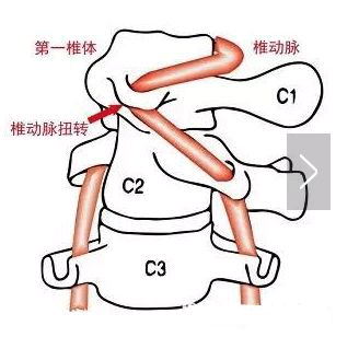 偏头痛该怎么办？