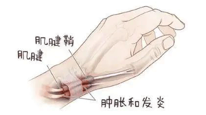 如何预防腱鞘炎？