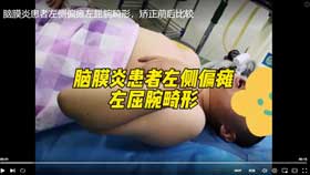 脑膜炎患者左侧偏瘫左屈腕畸形，矫正前后比较
