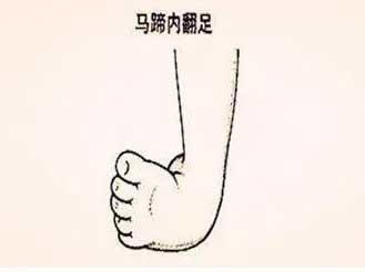 一旦发现孩子“脚弯弯”? 需要您 “足”够重视