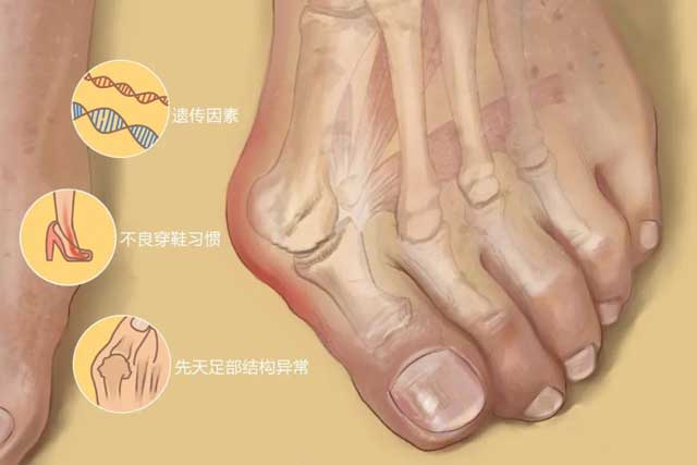 常穿高跟鞋、尖头鞋女性谨防拇外翻的发生！
