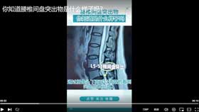 你知道腰椎间盘突出物是什么样子吗？