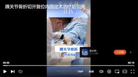 踝关节骨折切开复位内固定术治疗后引流