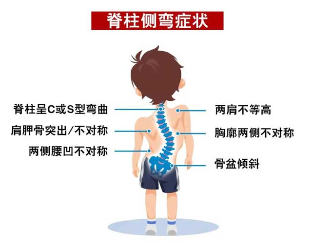 5.21脊柱健康日，家长要严防孩子脊柱侧弯的发生！