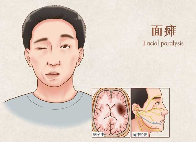 面瘫的常见原因知多少？神经修复事半功倍