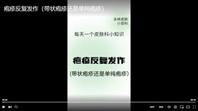 疱疹反复发作（带状疱疹还是单纯疱疹）
